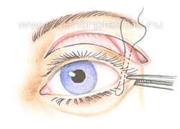 Операции на веках