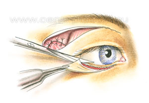 Операции на веках