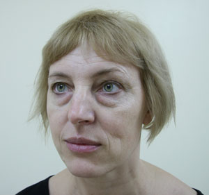 Блефаропластика и подтяжка средней зоны лица