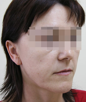 Эндоскопическая подтяжка лица