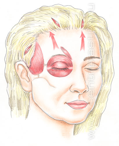 Эндоскопическая подтяжка лица