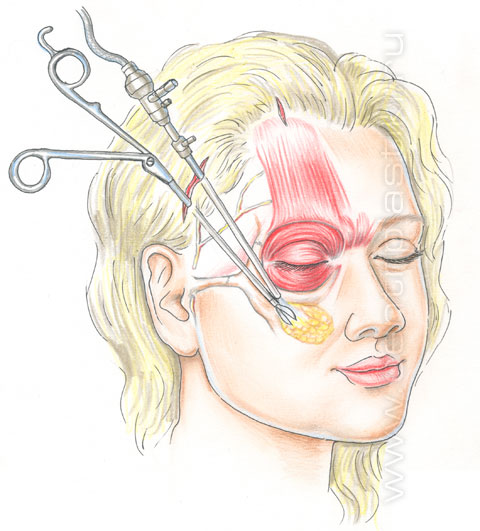 Эндоскопическая подтяжка лица