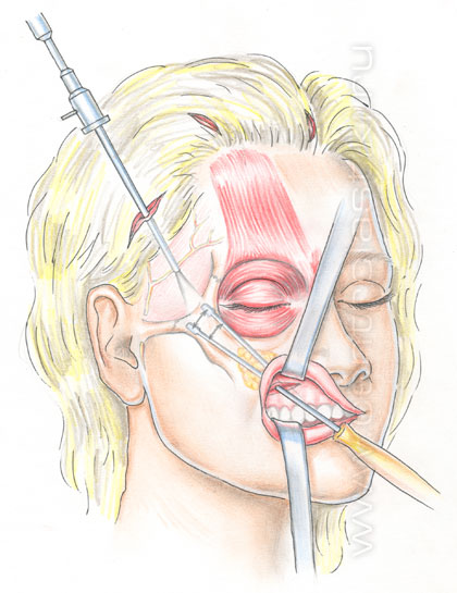 Эндоскопическая подтяжка лица