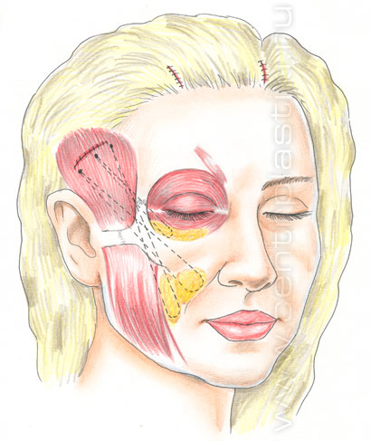 Эндоскопическая подтяжка лица