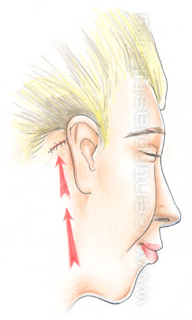 Эндоскопическая подтяжка лица