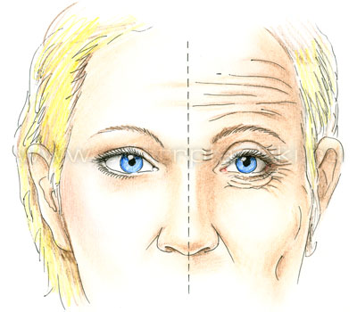 Эндоскопическая подтяжка лба и бровей