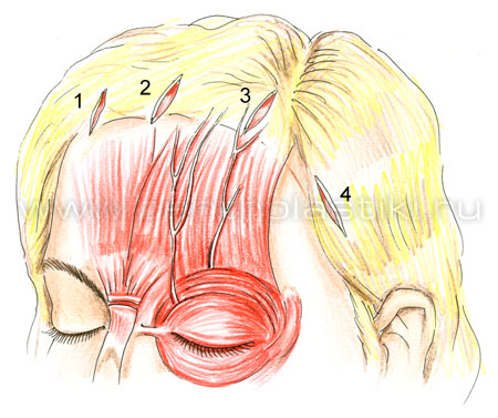 Эндоскопическая подтяжка лба и бровей