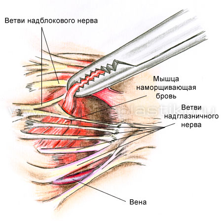 Эндоскопическая подтяжка лба и бровей