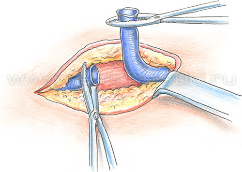 Лечение варикозной болезни