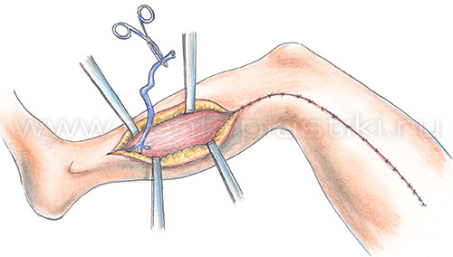 Лечение варикозной болезни