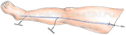 Лечение варикозной болезни