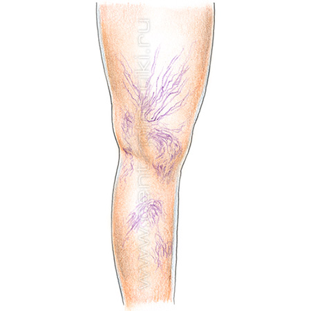 Сосудистые звездочки