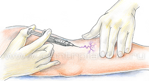 Сосудистые звездочки