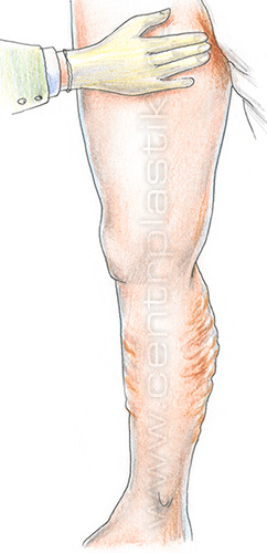 Диагностика варикоза