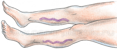 Диагностика варикоза