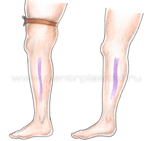 Диагностика варикоза