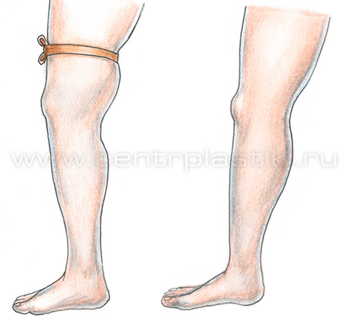 Диагностика варикоза