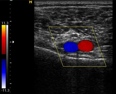 Диагностика варикоза