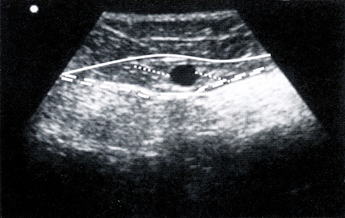 Диагностика варикоза