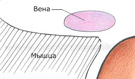 Диагностика варикоза