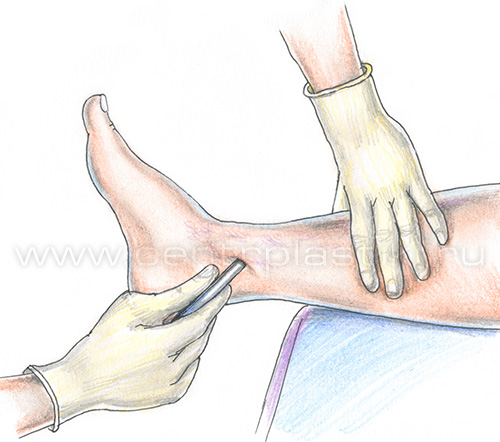 Диагностика варикоза