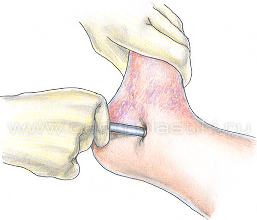 Диагностика варикоза