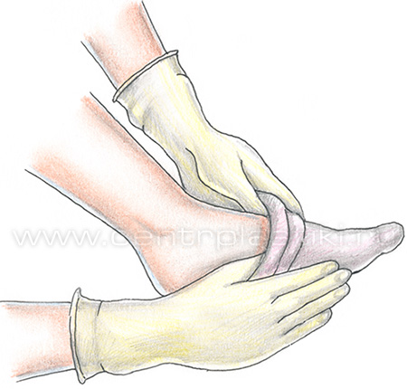 Лечение варикоза