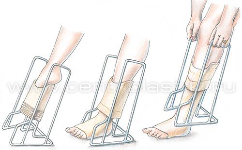 Лечение варикоза