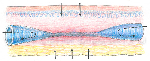 Лечение варикоза лазером