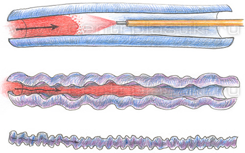 Лечение варикоза лазером