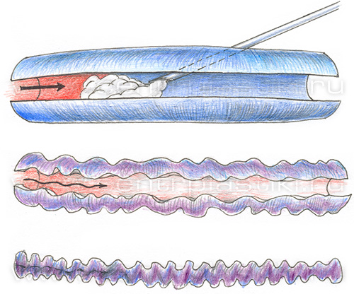 Склеротерапия