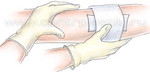 Склеротерапия