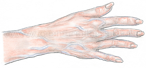 Склеротерапия