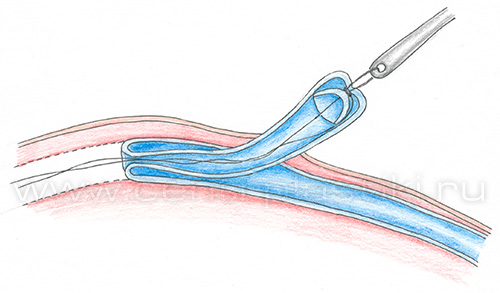 Флебэктомия