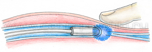 Флебэктомия