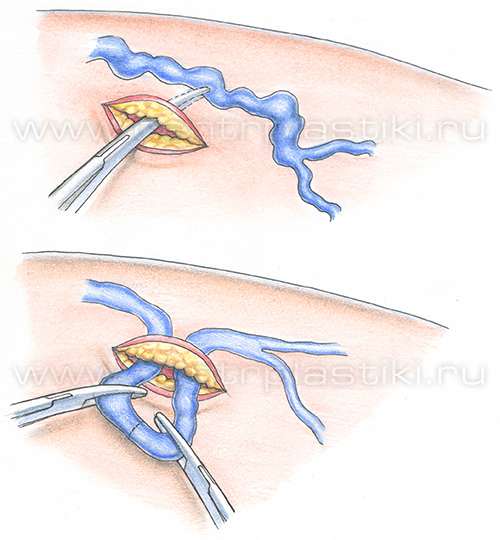 Флебэктомия