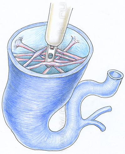 Флебэктомия