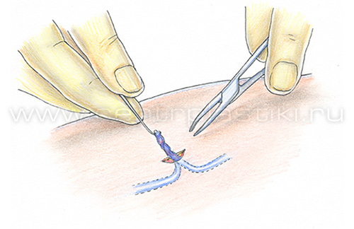 Флебэктомия