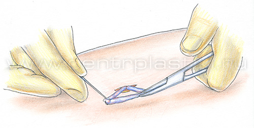 Флебэктомия