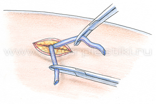 Флебэктомия