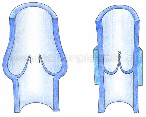 Флебэктомия