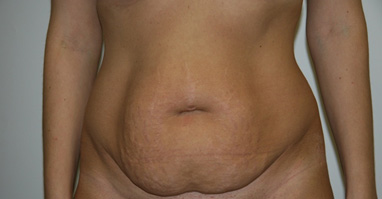 Абдоминопластика