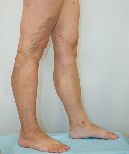 Флебэктомия