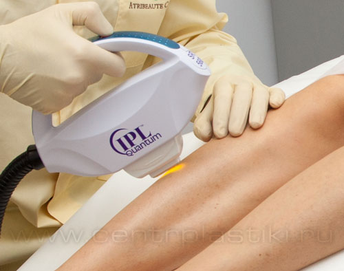 Фотоэпиляция (удаление волос)