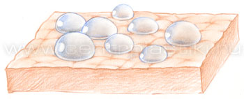 Гипергидроз (потливость)