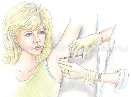 Лечение гипергидроза (потливости) подмышек