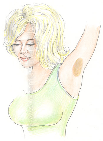 Гипергидроз (потливость)