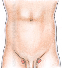 Бедренная грыжа