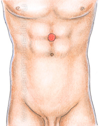 Грыжа белой линии живота