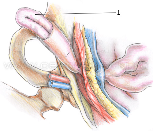 Косая паховая грыжа